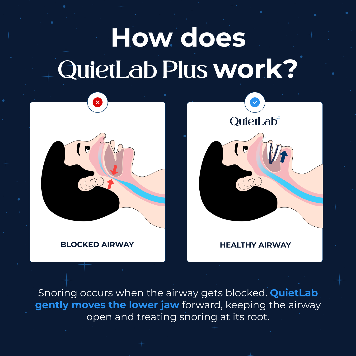 QuietLab Plus® Anti-Snoring Mouthpiece